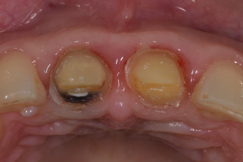 Fig. 13: The horizontal view shows the oro-facial dimension prior to tooth extraction