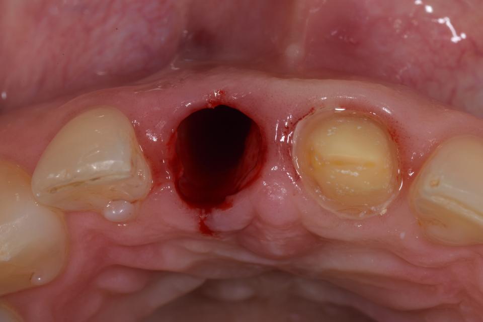 Fig. 14: Tooth extraction is performed with flap elevation and revealed an intact but thin buccal bone plate 