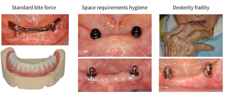 Fig. 7: At the University of Bern a phased approach is followed for edentulous patients, depending on anatomy and functional capacity. We prefer two-piece implants placed with minimally invasive surgery and adapted to co-morbidities. The length and diameter should be as small as possible, but as large as necessary
