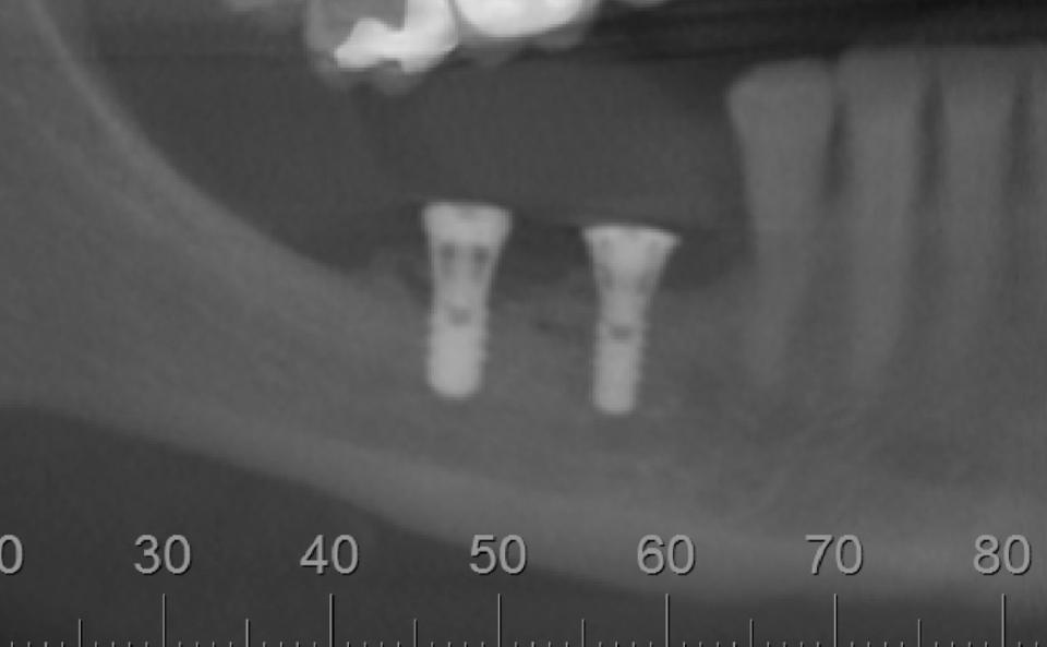 Fig. 3i: Postoperative radiograph after implants placed (Straumann TL, SLActive, 3.3 x 8 mm RN and 4.1 x 8 mm RN)