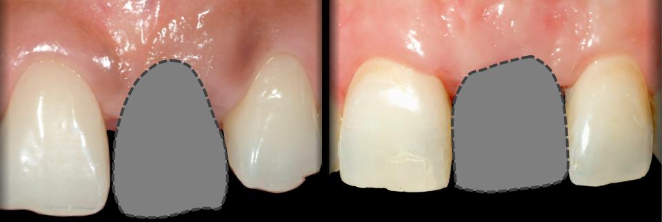图. 3: 修复体形态(缺牙间隙)对种植体尺寸及位置的影响。左侧图片显示尖圆形牙冠，需要种植体植入更深的位置及更窄的穿龈轮廓。右侧图片显示方圆形牙冠，允许种植体植入深度更偏冠方