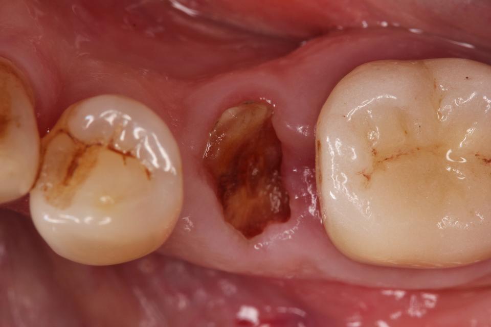 Fig. 7: Clinical situation with failing bicuspid with thick surrounding soft and hard tissue