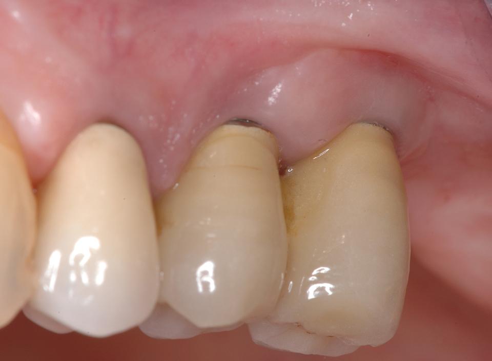 Fig. 7c: The clinical status at the 20-year follow-up. The peri-implant soft tissues are healthy