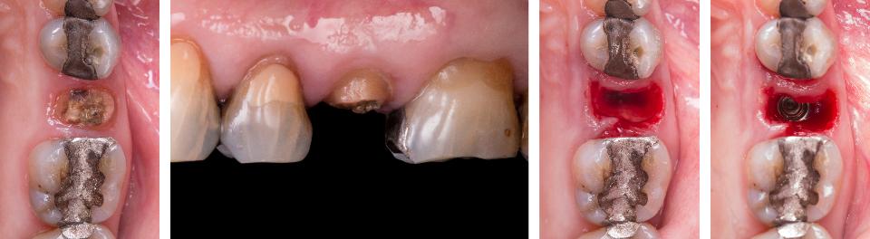 Fig. 3a: This case illustrates the indirect construction of a provisional crown to be attached to an immediately placed implant (type 1A) protocol. Two methods are shown – an analog approach and a digital approach:
Occlusal view of a maxillary first premolar site following immediate placement of an implant