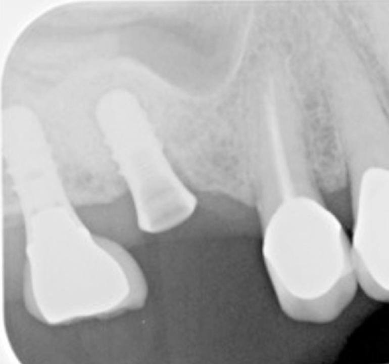Fig. 3c: Die periapikale Röntgenaufnahme nach dem Entfernen der Krone zeigte keine signifikante Veränderung der Knochenhöhe gegenüber dem Ausgangswert. Gut zu erkennen ist jedoch die konsistente dünne strahlendurchlässige Schicht rings um das Implantat in Position 16.