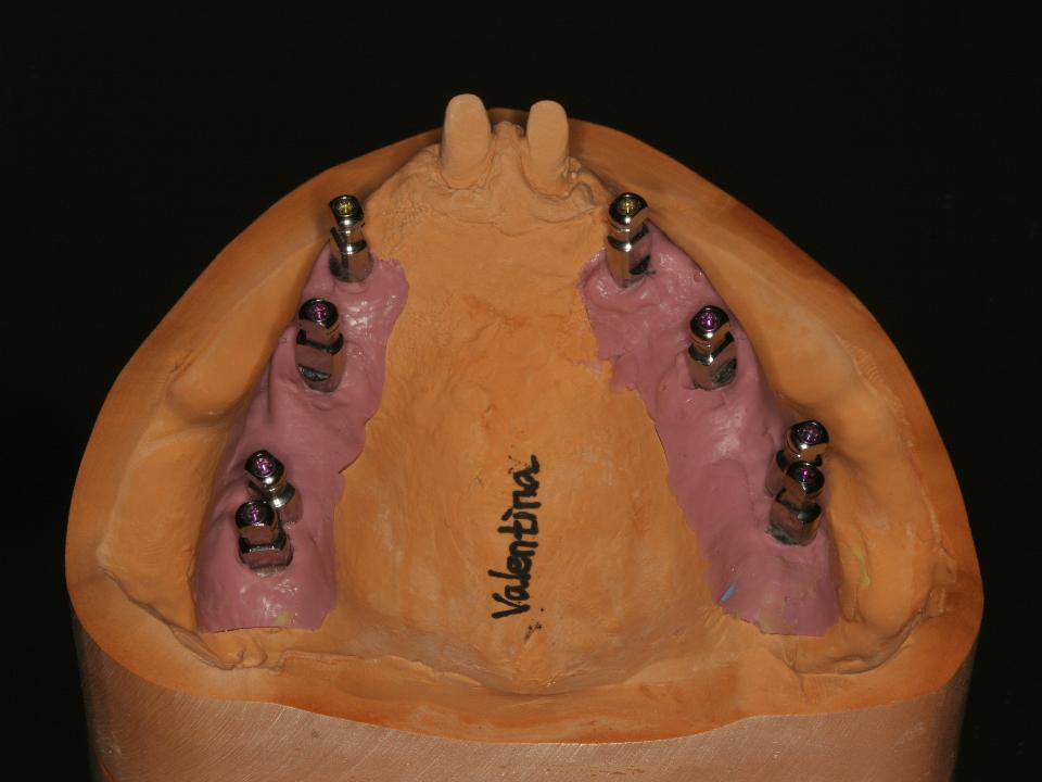 図6d: 上顎の最終作業模型。形成した2本の中切歯と、無歯顎領域に8本のインプラントを含めて最終補綴装置を製作する