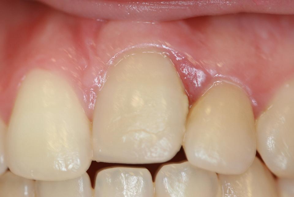 図8b: 歯槽堤保存術。歯冠が灰色に変色している転位した21番のクローズアップ。22番に面した乳頭は炎症を起こしているように見える。
