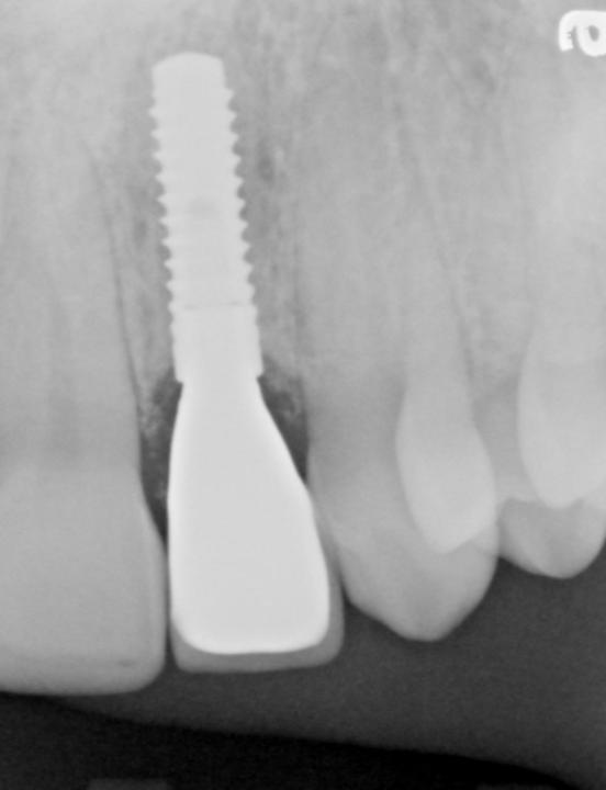 Fig. 2p: Radiographic control 2 years after extraction and immediate implant placement