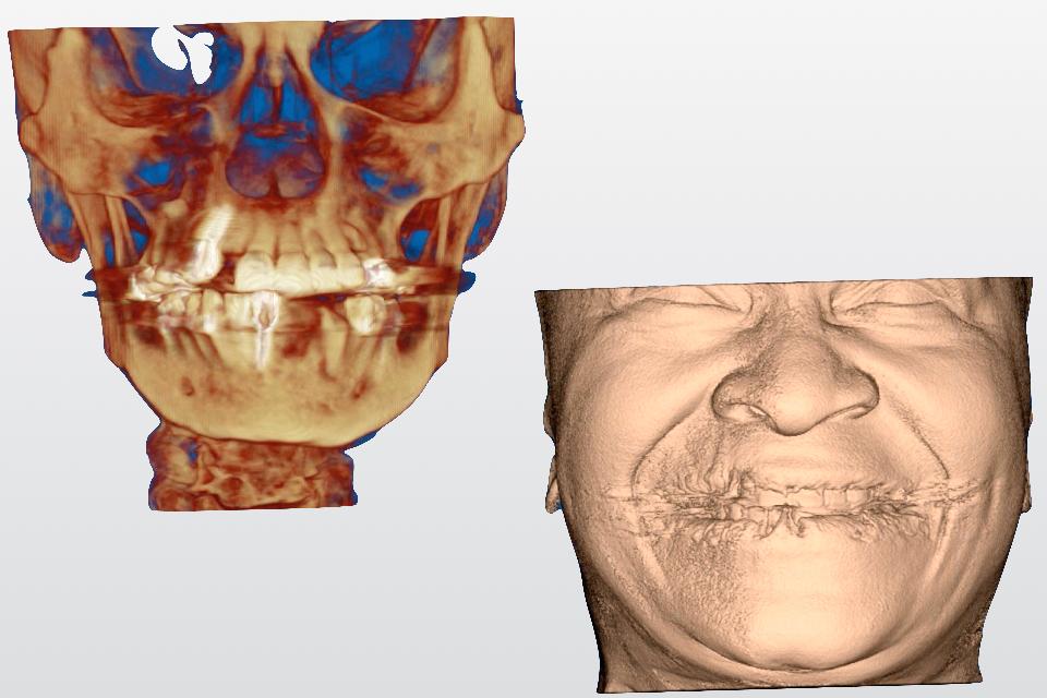 Fig. 18: Although CBCT allows the 3D imaging of the craniofacial hard tissue, it only has a limited field of view and contrast resolution for facial soft tissue