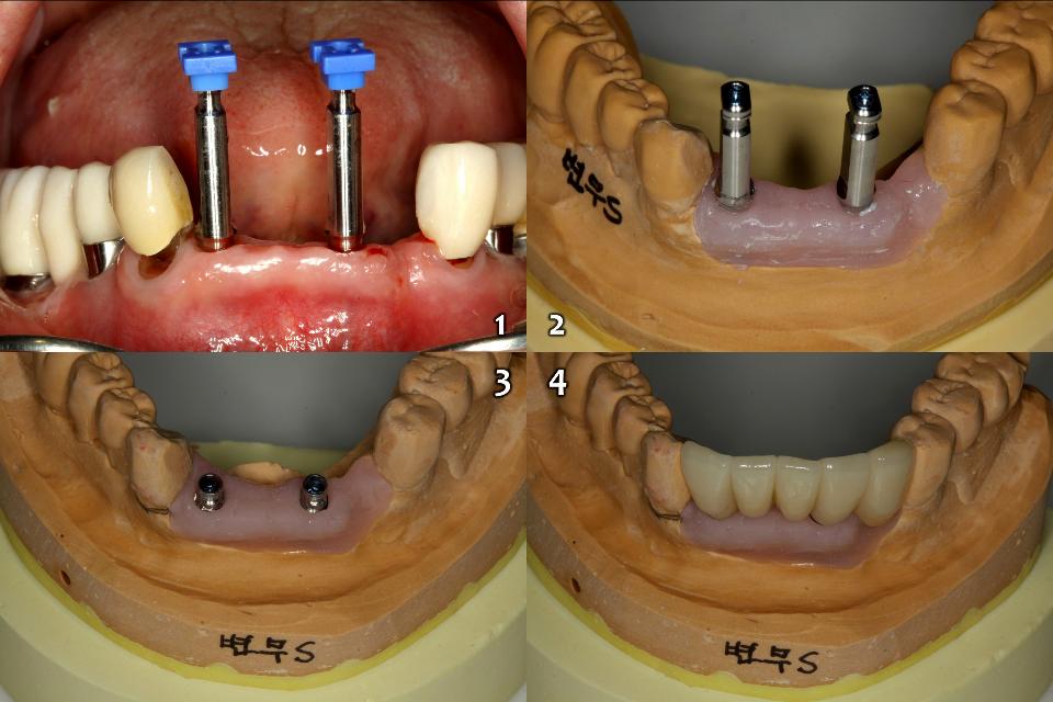 Fig. 10g: The final impression taking was carried out 2 months later (1), and the single unit definitive zirconia restoration (Prettau, Zirkonzahn, Gais) was fabricated by CAD/CAM workflow (2 - 4)