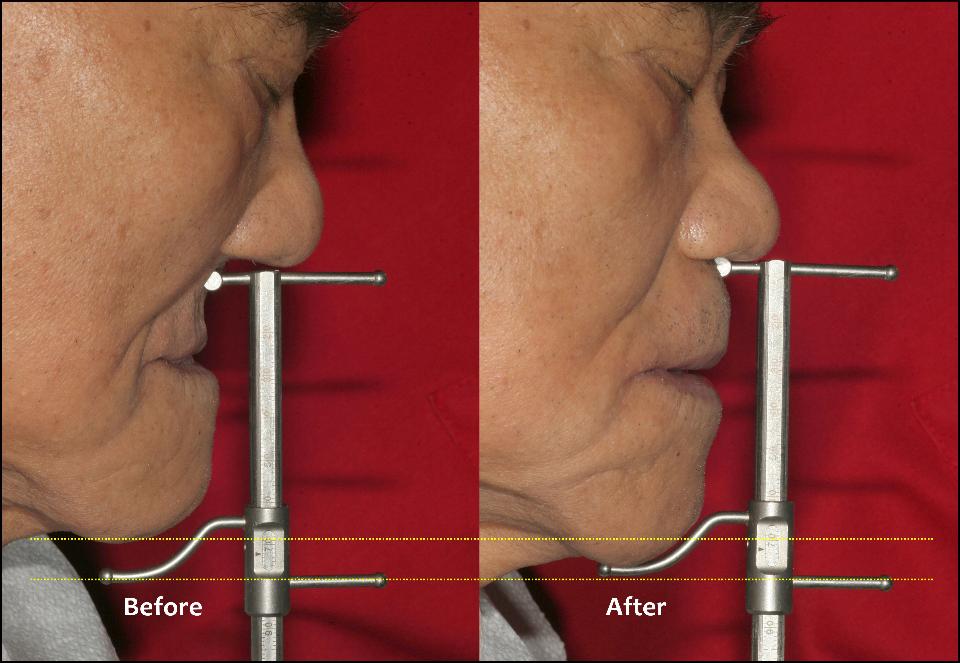 Fig. 13c: Aspect latéral du visage du patient avant et après l'installation des IOVD magnétiques supérieurs et inférieurs. Grâce à la combinaison des IOVD magnétiques supérieurs et inférieurs, ce patient âgé est parvenu à bien mâcher et à gérer lui-même les soins d'hygiène de manière très confortable depuis 2006 (69 ans à l'époque).