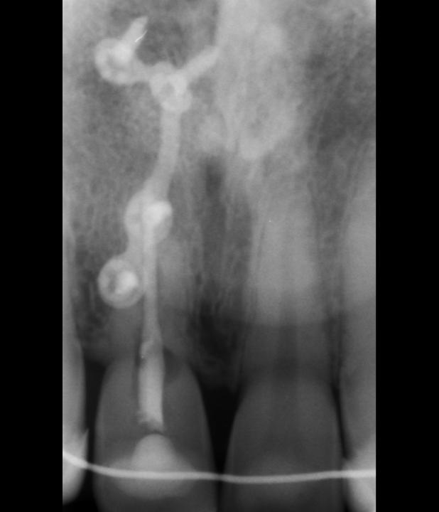 Resim 7h: Sandviç osteotomi tekniği. Alınan periapikal radyografi de ankiloze diş kökünde yavaş ilerleyen kemik replasmanı gözleniyor. 