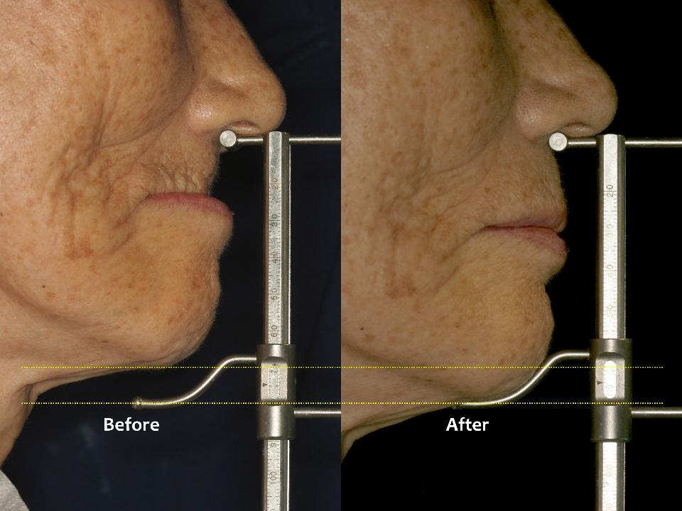 Fig. 11b: Lateral facial appearance of the patient before and after installing the maxillary CD. With a combination of upper CD and lower 4-implant fixed hybrid restorations, this elderly patient has come to chew well and very comfortably for more than 12 years since 2007 (72 years old at the time)