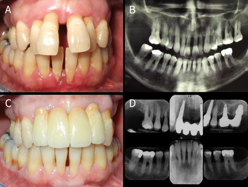 図2: 広汎型歯周炎ステージIVグレードCに罹患した41歳女性患者の写真（A）とパノラマX線写真（B）。歯周治療と抜歯を行い、歯周病が安定した時点でインプラント治療を行うハイブリッドアプローチが選択された。5年間の経過観察で良好な安定性が認められた（C,D）。