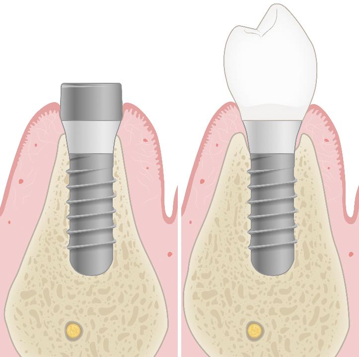 Fig. 12: Saucerization may occur in response to the subcrestal position of tissue level implants. This minimal bone loss is not associated with a greater risk of peri-implant infection