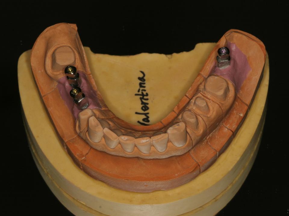 図6e: 最終補綴装置を製作するための、下顎の最終作業模型