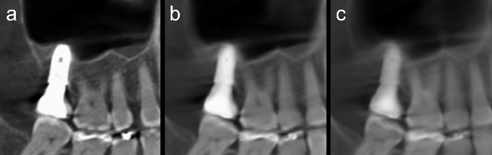 Fig. 11: Cone-beam computed tomography sagittal reconstruction at a slice thickness of 0.08 mm (a), 2 mm (b), and 5 mm (c). The relationship between the apex of the dental implant and the inferior cortex of the maxillary sinus becomes increasingly visible as the slice thickness increases. This, combined with the absence of sinus reaction, provides relevant evidence of normality