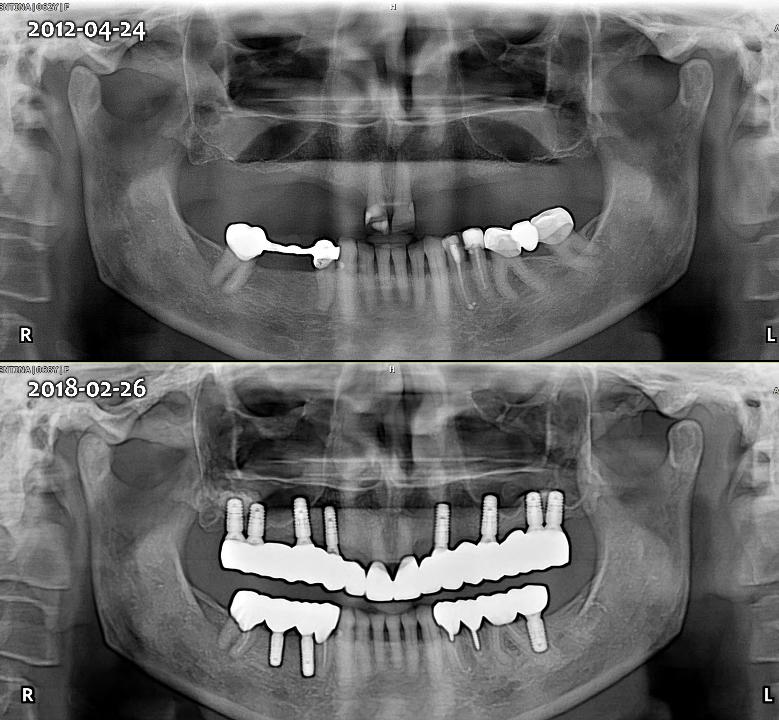 Fig. 6j: Initial panoramic view (upper) before treatment in 2012 and a check-up panoramic view (lower) in 2018 after treatment. This treatment option as the 1st priority was so-called ‘Natural tooth-like fixed restoration method’ that placed multiple implants over 6 on the edentulous area with both maxillary sinus grafts