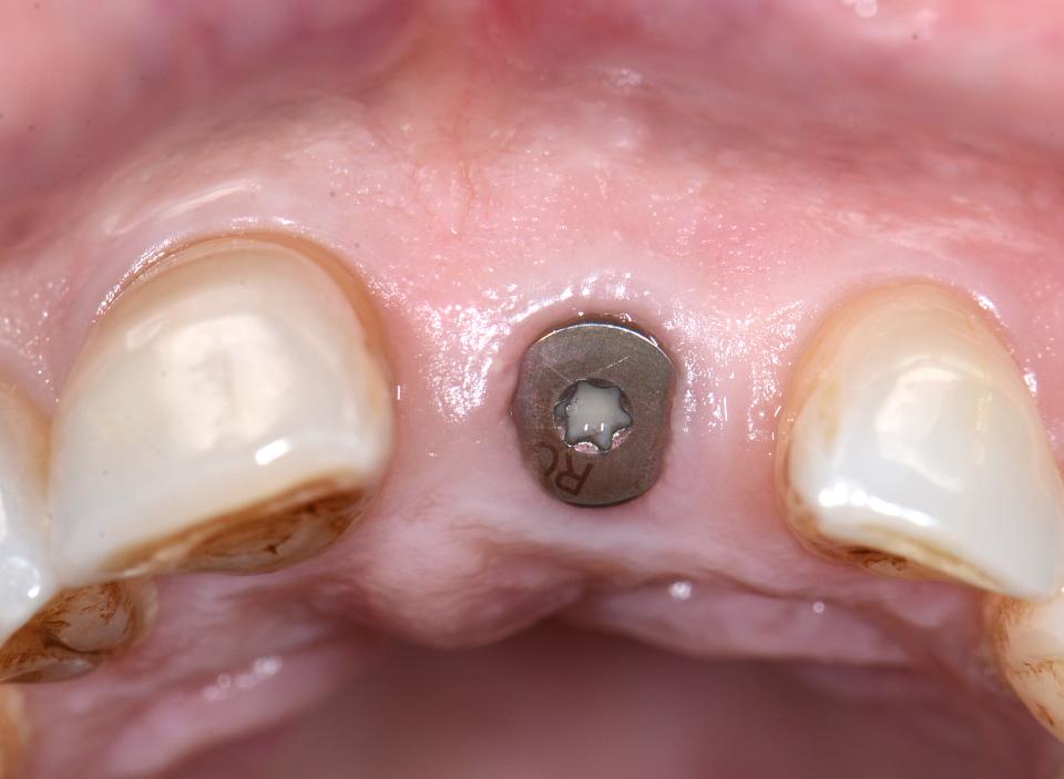 Fig. 5l: Clinical situation 12 weeks after implant placement (occlusal view)
