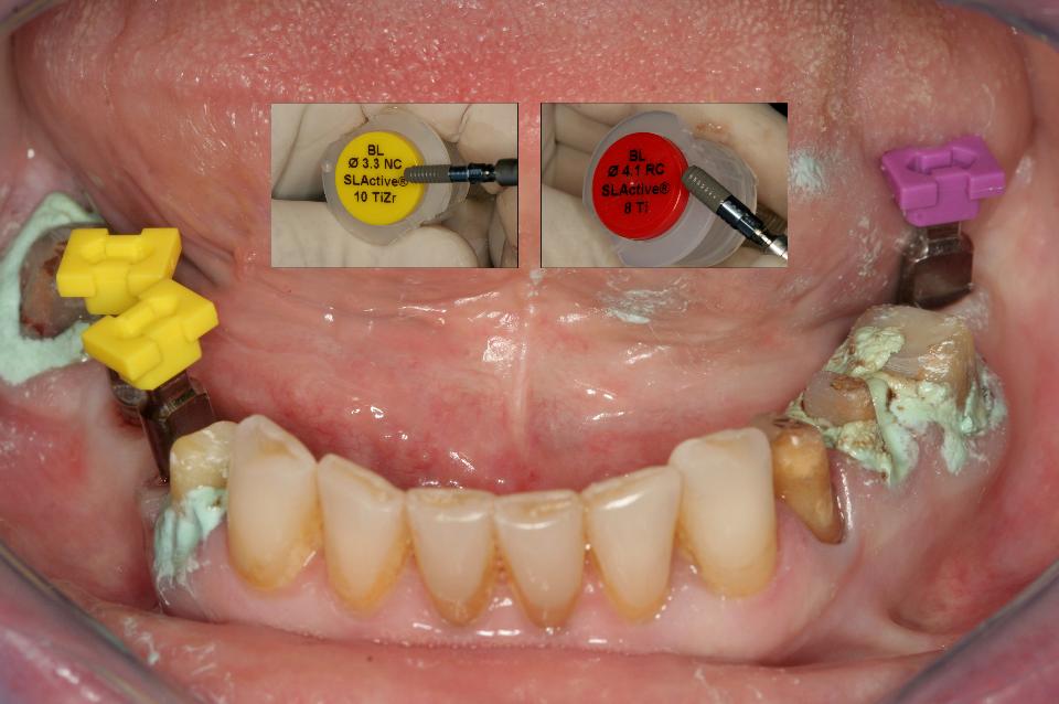 Fig. 6c: Cinco dentes naturais inferiores foram preparados para coroas e 3 implantes colocados no rebordo edêntulo inferior para as restaurações fixas. Foram selecionados nesse caso 2 Implantes Straumann Narrow Diameter (BL, 3,3x10, NC, Roxolid, SLActive, Straumann,) para o 2º pré-molar e 1º molar inferior direito, e 1 implante Straumann (BL, 4,1x8,0, RC, Ti, SLActive, Straumann) para o sítio do 2º molar inferior esquerdo.