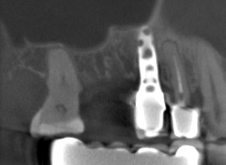 Fig. 4a: Panoramic CBCT view of a single posterior tooth gap in area 16 in an 87-year-old patient. The adjacent hollow-cylinder implant has been in place for more than 20 years. The ridge height is borderline with more bone volume in the mesial area
