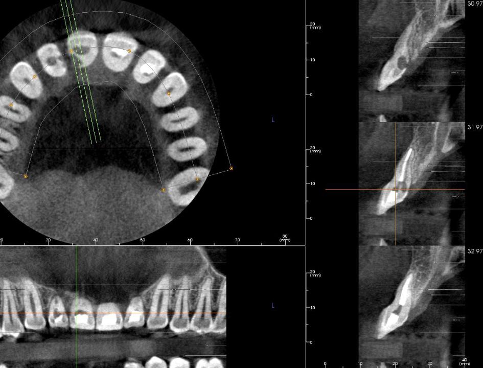 Fig. 5b: Patient 2, CBCT radiographs highlighting root resorption of teeth 11 and 12