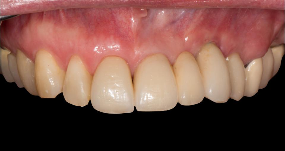 Fig. 5c: Coroa unitária de zircônia fundida com porcelana e prótese dentária fixa de três elementos foram cimentadas sobre implante de zircônia de uma peça pelo protesista Dr. Thomas Borer. (Crédito da foto: Stefan Roehling)
