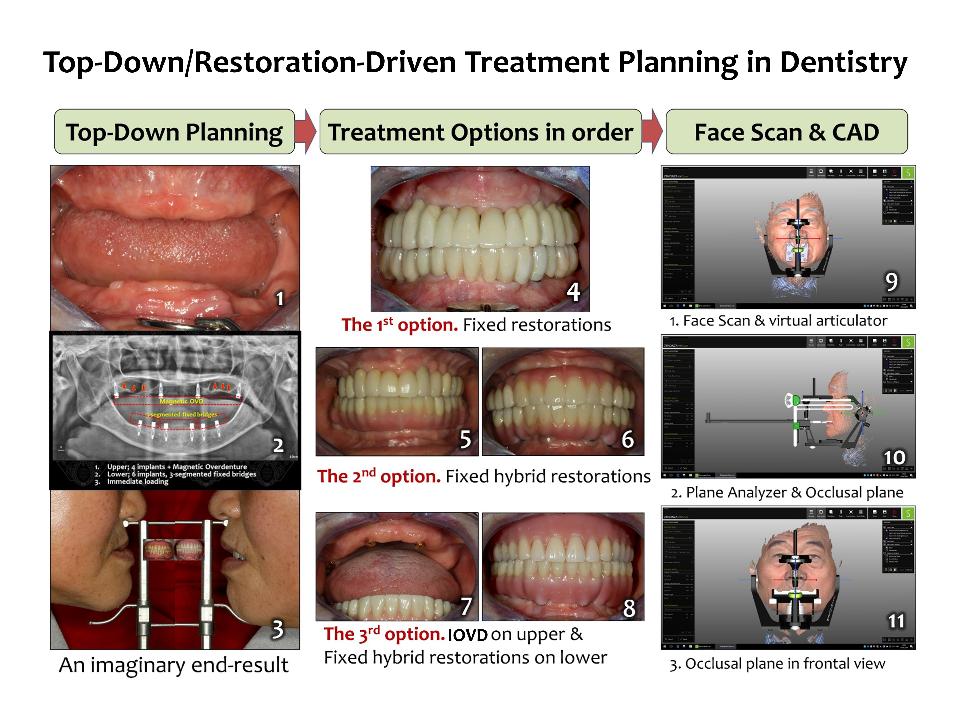 Fig. 4: The concept of top-down treatment in implant dentistry is like an architect's approach to designing a new building. It is a concept of therapy that can be imagined using paints to draw the result (1 - 3). From the clinical aspect, the concept of top-down treatment (Leesungbok 2004) is part of a global trend, where surgical placement is performed only after the visualization of the final prosthetic design is completed (4 - 8). While implant treatment in each country was initially practiced mainly from surgery, in recent years, pioneering countries and dental universities have formed a structural top-down collaboration that consults and takes charge of everything from prosthetics to initial treatment planning, selection of implant systems, and management after installation of prostheses. Increasingly, research on the superstructure proceeds mainly from the perspective of 3D geometric analysis, and the results are continuously applied to clinical practice (9 - 11).
