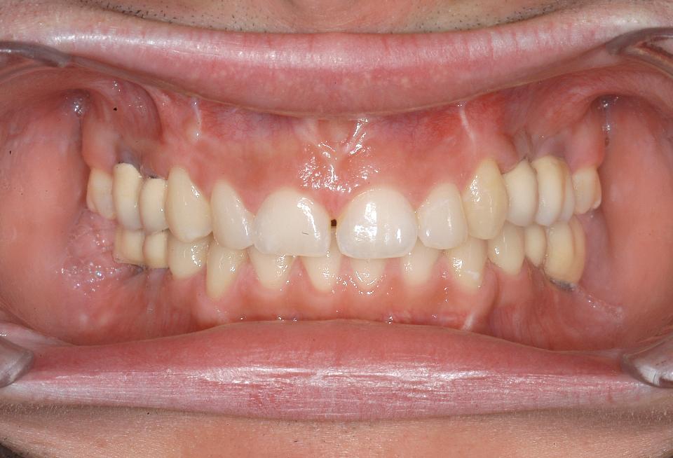 Şekil 6a: Hastanın diş eksikliklerinin implant destekli protetik restorasyonlar ile rehabilitasyonu: Frontal açıdan görünüm