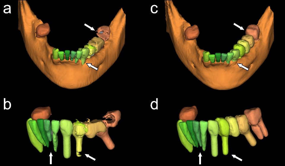 Fig. 15: Rendus volumétriques 3D de tomographie à faisceau conique avant (a et b) et après (c et d) l’apprentissage par intelligence artificielle de la mandibule (a et c) et des dents mandibulaires (b et d) à l’aide de Relu® Creator, plate-forme logé dans le cloud (Relu, Louvain, Belgique). Les flèches blanches indiquent les zones où l’exactitude de la segmentation est significativement différente avant et après l’entraînement de l’intelligence artificielle. Avec l’aimable autorisation du Dr Bahaaeldeen M. Elgarba et de la Pre Reinhilde Jacobs.