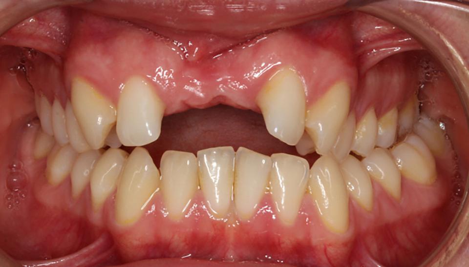 Resim 5a: Ortodontik olarak kapatılması. Daha önce gerçekleşen travma kaynaklı avülse olmuş ve ardından replante edilmiş olan ancak travma sonrası anklioze olmuş 11 ve 21 numaralı dişlerin cerrahi çekimi sonrası klinik görünüm.  2 santral keser dişin infrapoziyonu kaynaklı oluşan open-bite'a dikkat edin. 