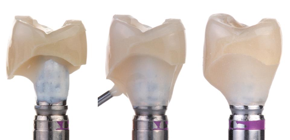 Fig. 3l: Once removed from the cast, additional material is added to recreate the desired emergence profile and fill any voids between the denture tooth and abutment. Care is taken to undercontour the first 1 –2 mm of the provisional to avoid contact with bone and to maximize soft tissue volume