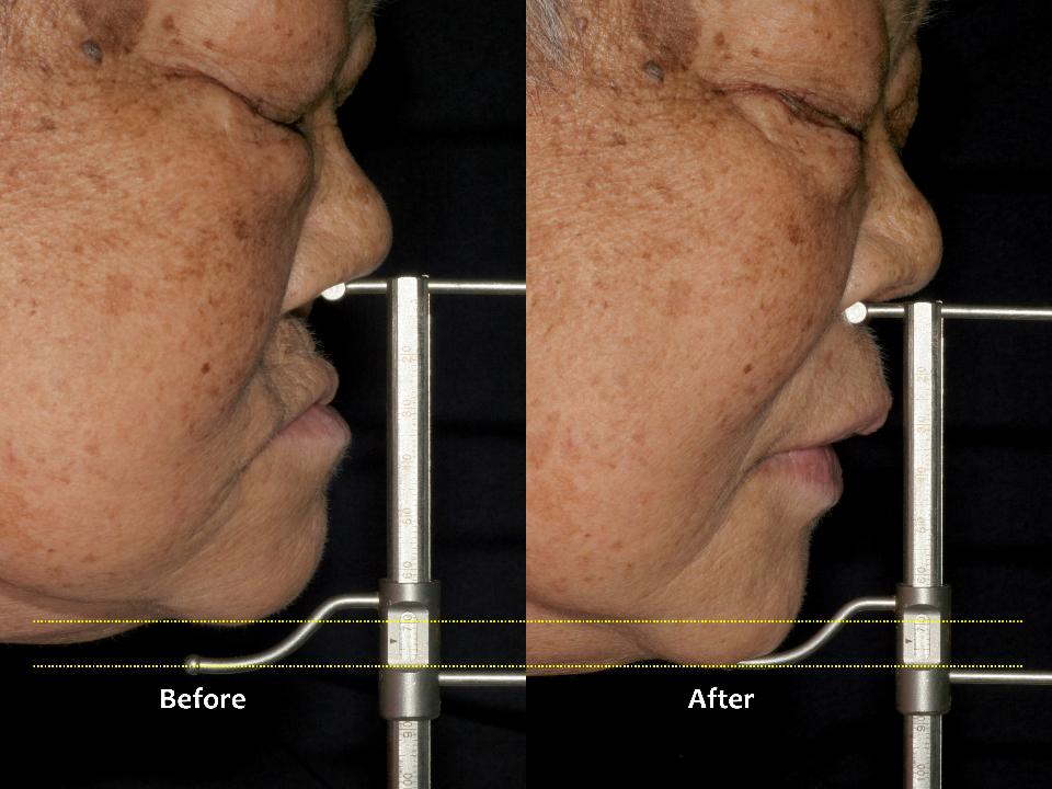 Fig. 12b: Lateral facial appearance of the patient before and after installing the prostheses. With a combination of upper CD and lower 4-implant fixed hybrid restorations, this elderly patient has come to chew well and manage hygiene care herself very comfortably since 2016 (79 years old at the time)
