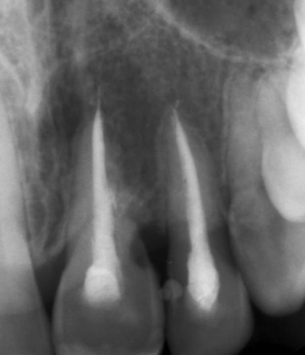 図8c: 歯槽堤保存術。21番と22番のデンタルX線写真。21番の遠心でアンキローシスを起こしている。歯内療法を施した22番の歯根膜腔に問題はない。