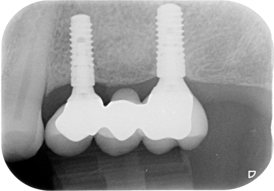 Fig. 13: Classic design of CAD/CAM frameworks; not supporting the veneering porcelain adequately