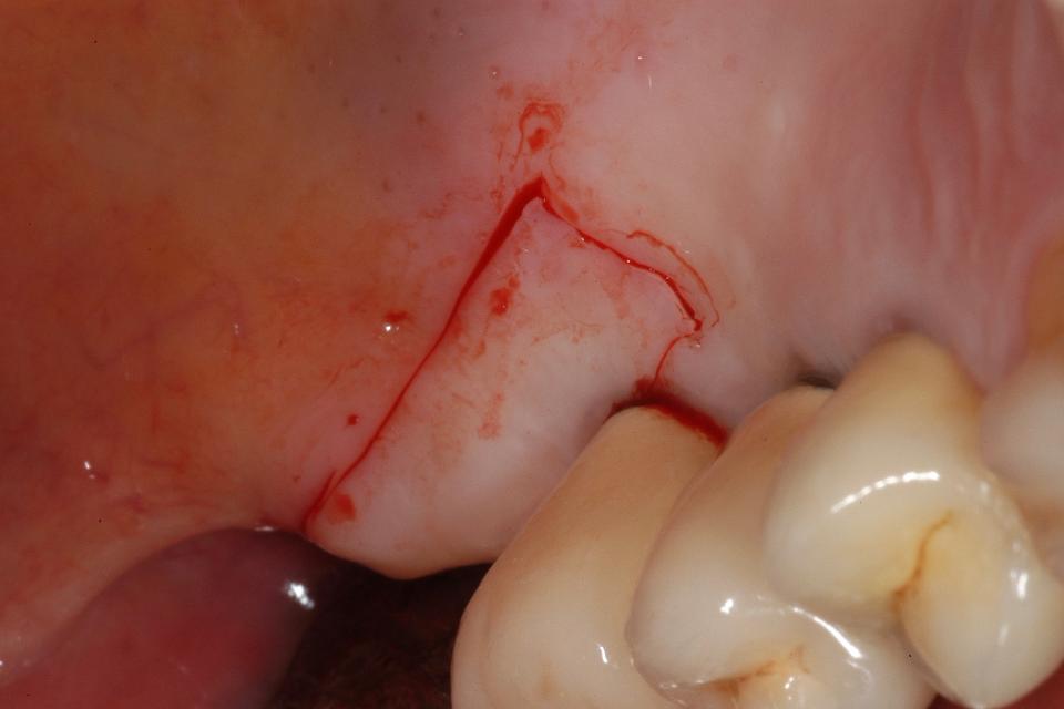 Fig. 4g: A free gingival graft (FGG) was proposed and accepted by the patient to improve the peri-implant soft tissues