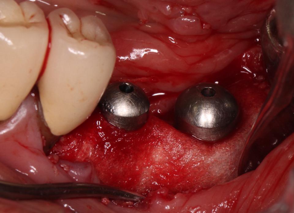 Fig. 2g: Guided bone regeneration (GBR) was carried out using allograft and a collagen membrane