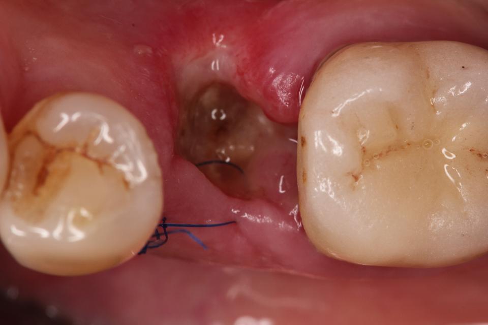 Fig. 9: One week after tooth extraction, the socket heals by secondary intention