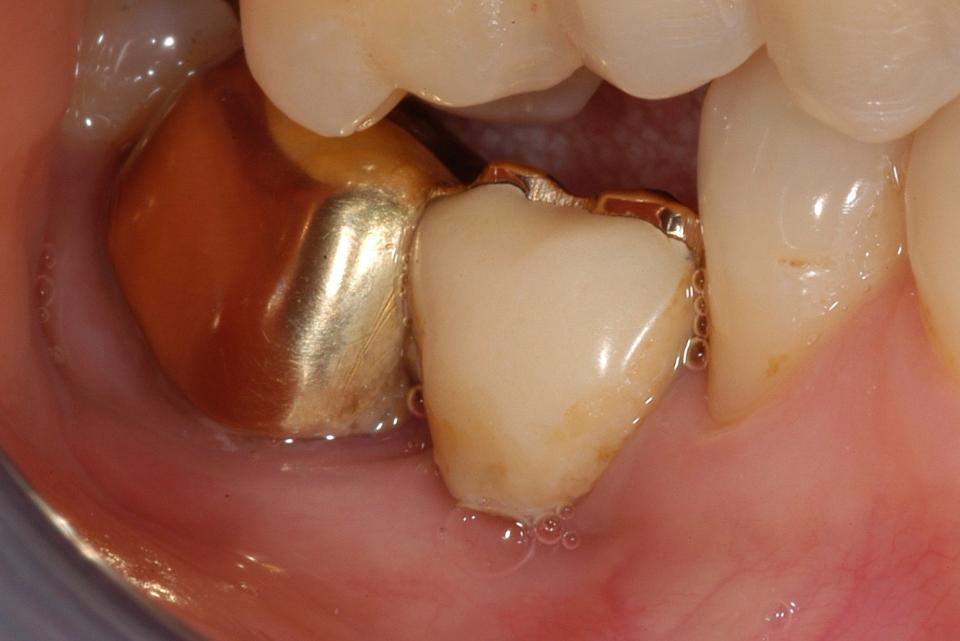 Fig. 3a: A 52-year old female, presenting an old mesial cantilever on the second molar, was seeking for placement of tooth 46