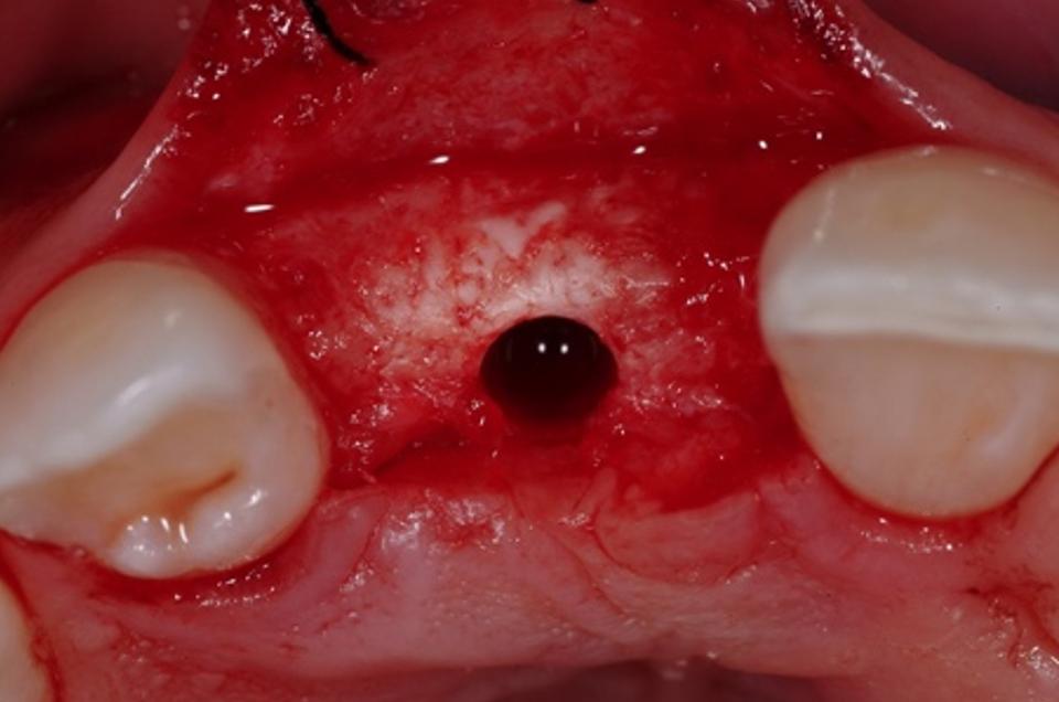 Fig. 7c: Type 4 implant placement: Optimal implant bed preparation allowing for thick buccal bone