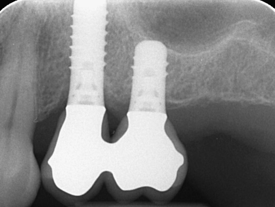 Fig. 3b: In the left maxilla, a short 6-mm implant is splinted to a longer implant to bypass a SFE procedure. Both TL implants have been in function for 4 years and have stable bone crest levels