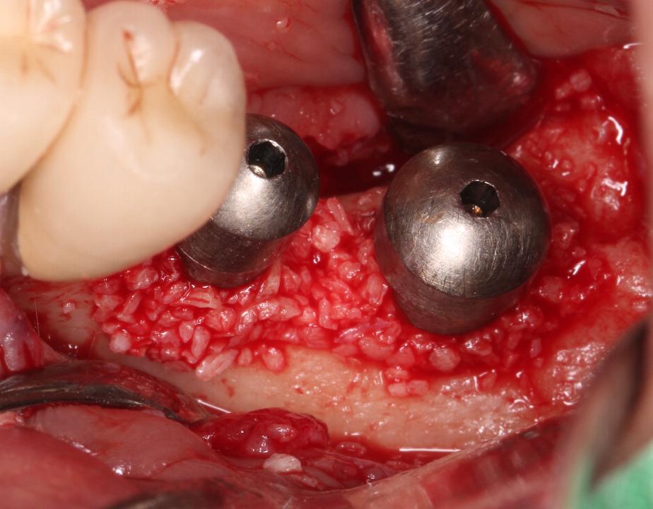 Fig. 2f: Guided bone regeneration (GBR) was carried out using allograft and a collagen membrane