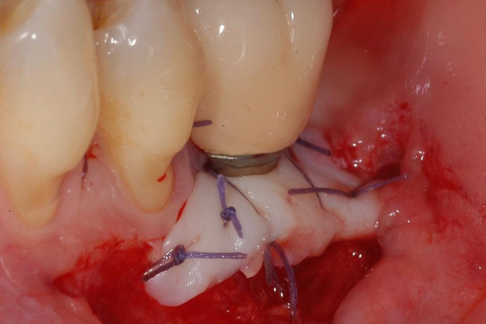 Fig. 4i: The FGG was sutured on a split thickness flap by means of 4-0 Vicryl™ around the smooth collar of the implant