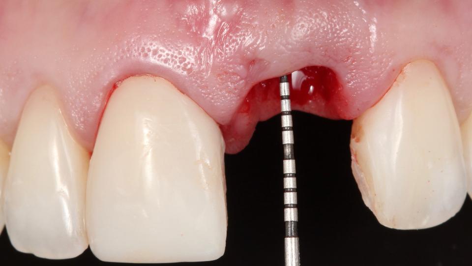 Abb. 2h: Minimalinvasives Verfahren zur lappenlosen Zahnextraktion – Inspektion der Alveolenwände mit einer Parodontalsonde