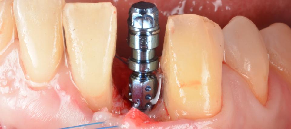 Fig. 10d: The effectiveness of narrow diameter implants relies on the adequate adjustment of occlusion to minimize biomechanical overloading. These can be considered a predictable minimally invasive alternative to preserve the critical buccal bone wall thickness