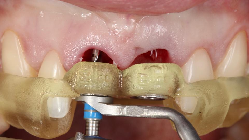 Fig. 5a: Utilización del protocolo totalmente guiado de cirugía de implantes asistida por ordenador estático para la colocación inmediata de implantes – región #11 – fresa piloto (ø2,2 mm) durante la preparación de la osteotomía