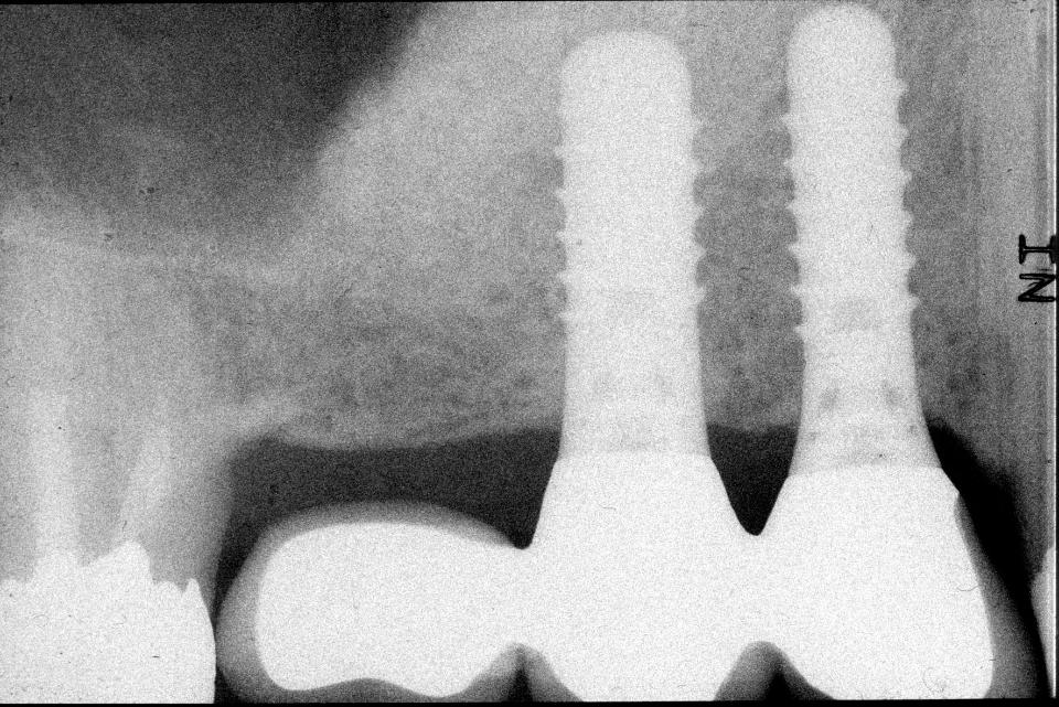 Fig. 6i: The 6-year follow-up radiograph shows excellent bone crest levels at both TL implants. The peri-implant bone structure has remodeled nicely over the years
