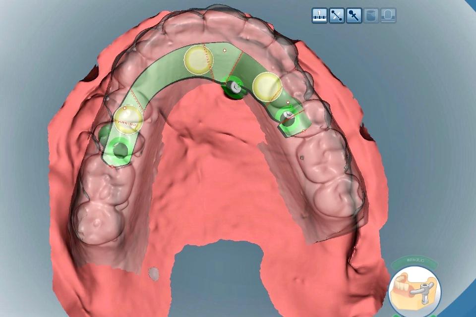 Fig. 12: Representation of scanned dental cast, and the design of CAD/CAM bar on 3 dental implants