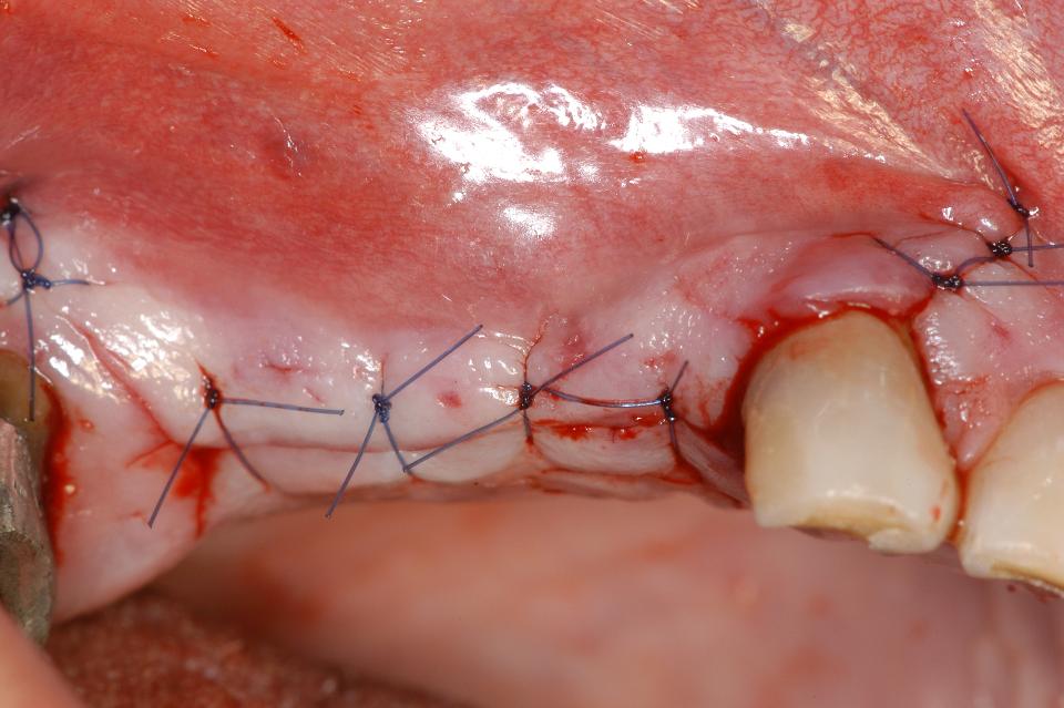 Fig. 6f: The SFE surgery was completed with a primary wound closure to protect the inserted implants against loading forces during healing