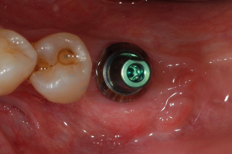 Fig. 4c: Occlusal view, at the cementation of the definitive crown, 3 months after implant placement